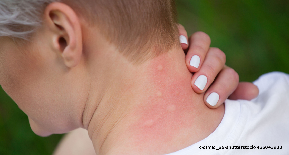 Ein Nacken eines älteren Kindes trägt mehrere große Mückenstiche.